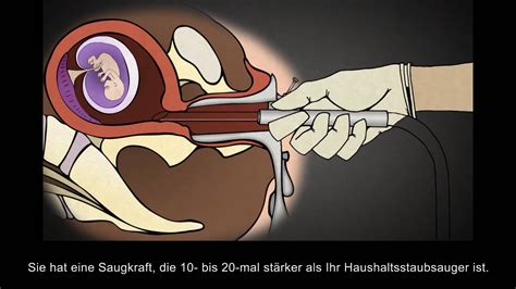 Die abtreibung darf maximal bis zur 14. Abtreibung durch Absaugung (Vakuumaspiration) im 1 ...