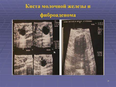 Предстательная желез диета Фиброаденомы Молочных Желез Диета — Похудение Диета Правильное Питание Фиброаденомы Молочных Желез Диета — Похудение Диета Правильное Питание Предстательная желез диета