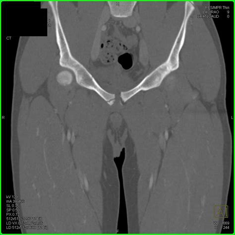 Fracture of the Right Superior and Inferior Pubic Ramus ...