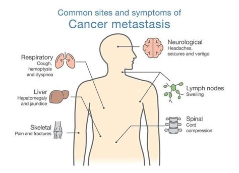 Although lung cancer that has spread to bone is not curable, there are treatments that can significantly increase survival times and improve your overall quality of life. 10 Warning Signs of Colon Cancer; Colon Cancer Symptoms ...