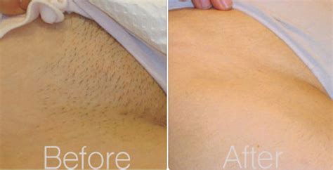 Richard has been doing the same job for 20 years. Oh No! Bad Ingrown Hairs After Brazilian Wax: What To Do?