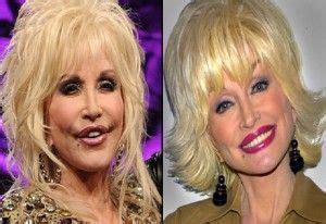 Eyelid Surgery - Blepharoplasty Dolly Parton Plastic ...