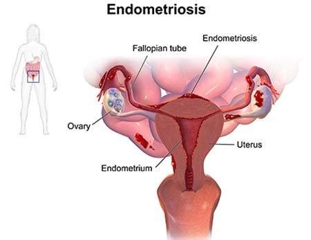 Find out about endometriosis including symptoms, diagnosis, treatment, patient stories, support, and more from an endometriosis community perspective. Endometriosis Treatment · Pelvic Pain Specialist · Dr ...