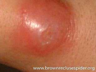 Single bites from black widow spiders can be lethal to small animals. Black Widow Spider Bite Pictures Symptoms