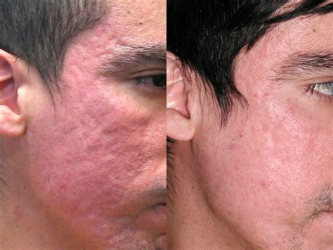 As we have understood, you want to get rid of your problem in 1 or 2 treatments. How to Fade Acne Marks?