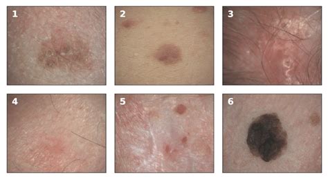 The earliest stage melanomas are stage 0 (melanoma in situ), and then range from stages i (1) through iv (4). Examples of melanoma and non-melanoma skin cancer taken in ...