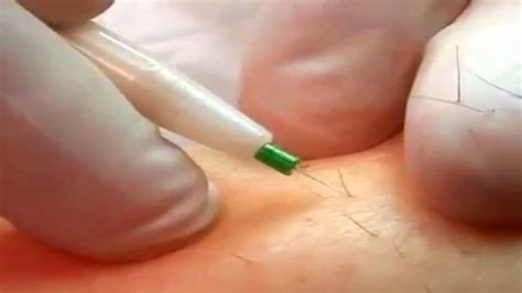 Healthstuff is a participant in the amazon services llc associates program. How To Do Electrolysis Hair Removal At Home - Grizzbye