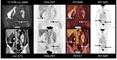 Allowing yourself to acknowledge and accept your feelings is the first step. 50-year-old female patient with ovarian cancer suspicious ...
