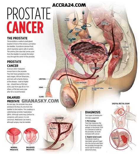 Because most of the symptoms come from its location. Prostate Cancer Signs, Symptoms & Prevention | GhanaPa.com ...