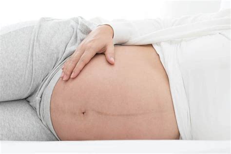 Linea nigra (latin for black line) is a dark vertical line that appears on the abdomen during about three quarters of all pregnancies. Linea Nigra - What It Is, Why It Happens And How Long It Lasts