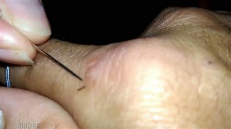 Splinters can be very annoying, especially for children who find the prospect of having splinters removed with a needle too traumatic to contemplate. Satisfying Splinter Video in Finger - YouTube