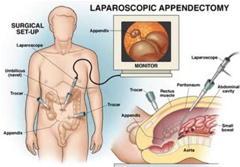Knowing where the pain from appendicitis starts from and eventually stays in, is very important in being able to recognize if. Appendix Pain - Location, Symptoms, Treatment and Surgery ...