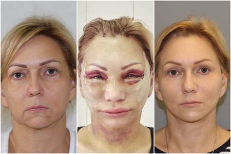 Джилиан майклс похудеть за 30 отзывы фото до и после Отзывы Эндоскопический Лифтинг Фото До И После — Картинки фотографии Отзывы Эндоскопический Лифтинг Фото До И После — Картинки фотографии Джилиан майклс похудеть за 30 отзывы фото до и после