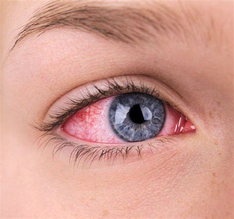 Obat mata merah cendo xitrol (obat mata. Penyebab Mata Merah, Gatal, Berair, Mengganjal, Bengkak ...