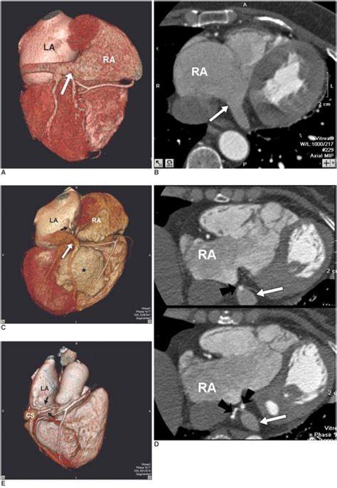 The opening between the sinus venosus and right atrium which has two valve leaflets to prevent backflow of blood. Congenital coronary sinus anomaly in 60-year-old woman ...