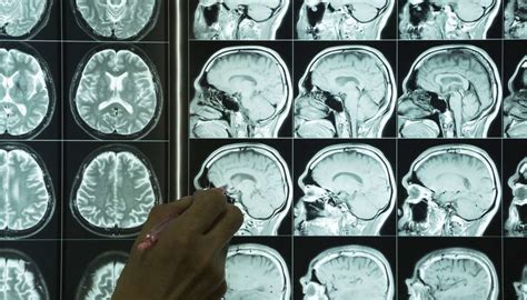 Everyone experiences mild cognitive changes as they age, turner notes. Dementia: Brain mapping method may predict progression