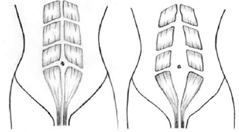 We did not find results for: Postpartum Diastasis Recti: Causes, Symptoms, and Home ...