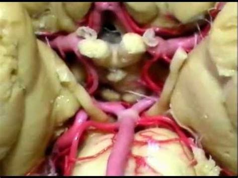 Explicamos sus causas, síntomas, tratamiento y pronóstico. NEUROANATOMÍA 2.0: IRRIGACIÓN DEL SNC 1/3; CIRCULO ...