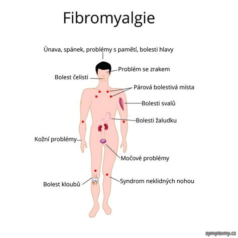 Fm, fibromyalgia syndrome (fms) fibromyalgia is a chronic pain disorder. Fibromyalgie - příznaky a léčba