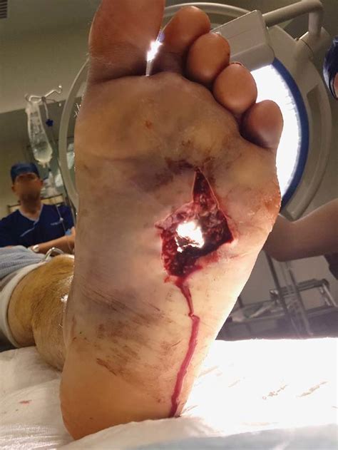 Skin splits are common in contact wounds of the head; shotgun injury of the left foot, pre-debridement. | Download Scientific Diagram
