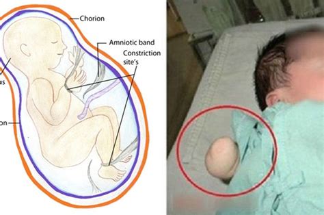 Namun, nyatanya cukup banyak yang tidak menyadari bahwa mereka tengah mengalami kondisi tersebut. Air Ketuban Sedikit, Tangan Sang Bayi Terputus Dalam Rahim ...