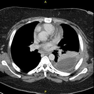 What procedures and tests diagnose pleural effusions? a Chest X-ray showing a pleural effusion post-LSG. b Chest X-ray... | Download Scientific Diagram