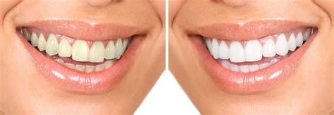 Crest noticeably white whitestrips makes it easy to whiten teeth and reveal a brighter smile, using proven for even more whitening power, brush your teeth twice daily with crest 3d white toothpaste. REASONS TO CONSIDER HAVING YOUR TEETH WHITENED - Belmont ...