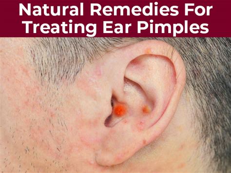 How do i get rid of a keloid on my ear? 10 Effective Natural Remedies For Treating Ear Pimples ...