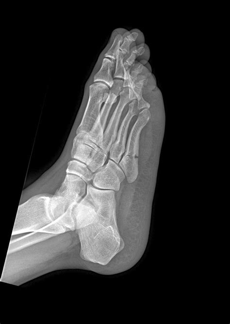 A Jones fracture is an extra-articular fracture at the ...