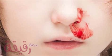 الدم في المنام سواء كان من الأسنان ، اللثة ، الأنف ، الفرج ، أو من آي جزء من الجسد يدل علي الكذب والغش والخداع والخُبث وذلك إن كان بكمية غزيرة ، وتفسير رؤية نزول الدم يختلف علي حسب الجنس هل صاحب الرؤية رجل أو إمرأة. ما هو تفسير حلم نزيف من الأنف في المنام؟ تفسيرات الخير ...