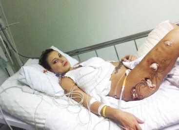 Imagens fortes de andressa urach no hospital após cirurgia para retirada do hidrogel de suas pernas. Agência divulga fotos da perna de Andressa Urach no ...