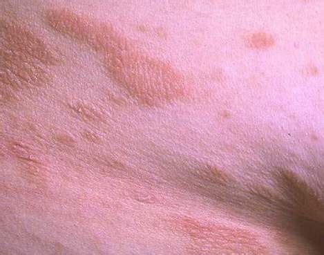 Tindakan yang umum dilakukan sebagai penanganan roseola adalah seperti. I BELIEVE THERE IS MORE IN YOU: Roseola Infantum