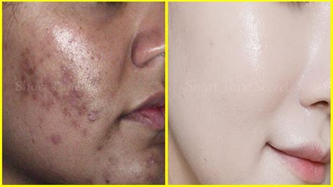 Dark spots are light brown or dark brown patches of skin. How to Remove BLACK SPOTS , DARK SPOTS & ACNE SCARS on ...