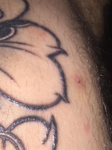 It can also be caused by a. Raised lines on near 4 week old tattoo that was nearly healed before I got another tattoo one ...