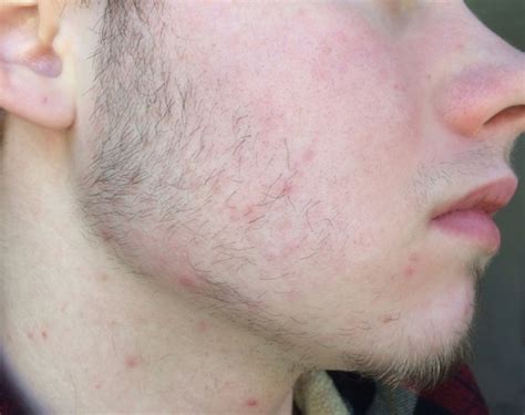 Development of body hair will usually. 17 y/o, 2 weeks, peach fuzz? - Beard Board