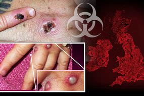 Maybe you would like to learn more about one of these? Monkeypox symptoms: What is Monkeypox - What are symptoms ...