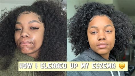 Eczema is a chronic condition that is not curable. How I Cleared Up My Eczema | My Eczema Journey PICTURES ...