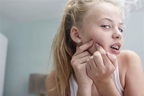 Teenage Acne-Causes Behind Acne And How To Get Rid Of Teenage Acne