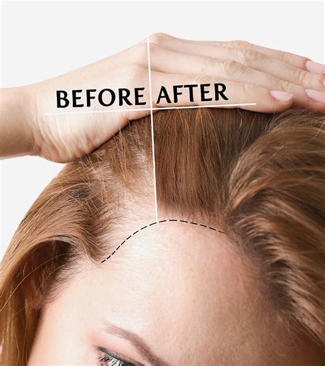 What is a hair transplant? Hair Transplant Growth Timeline: What Can You Expect?