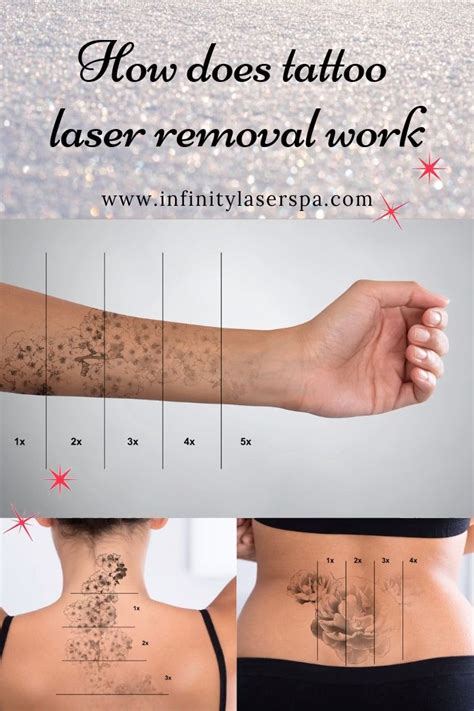 New york magazine recognized the laser & skin surgery center as offering the best tattoo removal in nyc, thanks to our specialized expertise, technology, and training. How Does Laser Tattoo Removal Work? - Infinity Laser Spa ...