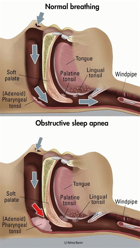 Get a quick overview of this common disorder which disrupts sleep: I have been diagnosed with severe sleep apnea. | Sam's ...