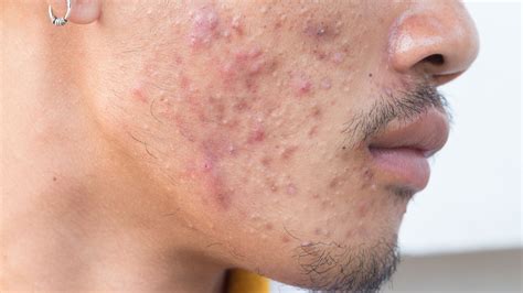 Nov 21, 2019·5 min read. Cara alami hilangkan bekas jerawat di wajah: Cara Nak ...