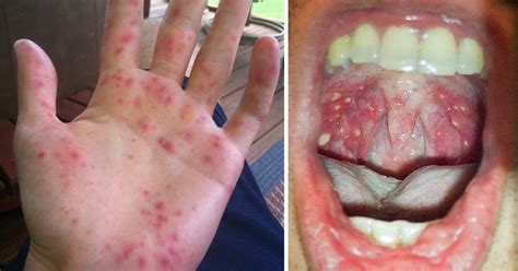 Check spelling or type a new query. Hand, Foot & Mouth Disease Outbreak! 6 Signs To Watch Out ...