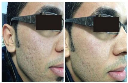 Another study demonstrated that an application using a combination of hyaluronic acid (ha) and vitamin c provided a visible improvement in scars that were more than 4 weeks old. The Efficacy of Topical Hyaluronic Acid Serum in Acne Scar ...