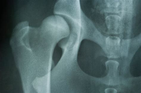 People always think the hip is dislocated when the problem usually stems from a bite or scratch which results in a painful swelling. Hip Dysplasia in Dogs | Causes, Treatment & More