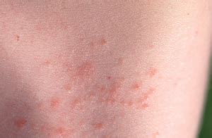 Is baby suffering from diaper rash? Rash on Breast Causes, Pictures, Itchy, Heat, How to Get ...
