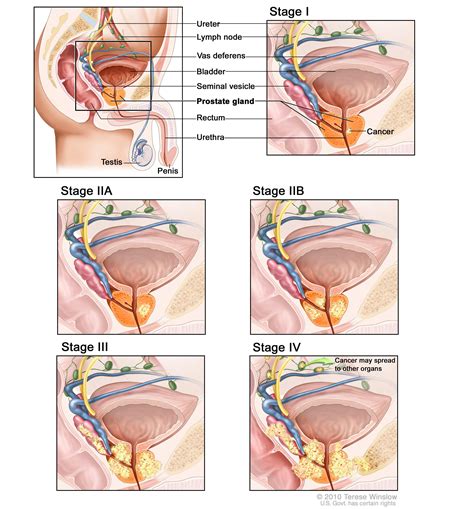 Your doctor uses the information from these tests to assign your cancer a stage. Prostate Cancer Treatment (PDQ®)—Health Professional ...