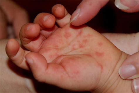 Coxsackievirus a type 16 (cv a16) is the etiologic agent involved in most cases of hfmd, but the illness is also associated with. "Massive Outbreak" of Hand, Foot and Mouth Disease in ...