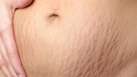 Stretch marks can cover an extensive area and the tattoo, thus, needs to be elaborate enough to cover the entire area effectively. This Tattoo Artist Is Covering Stretch Marks With Skin-Colored Ink and The Results Are AMAZING ...