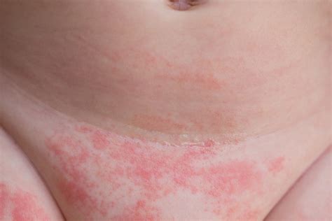 Eine windeldermatitis ist der hautausschlag in der windelregion bei säuglingen und kleinkindern, aber auch älteren menschen. Windeldermatitis - Behandlung und Vorbeugung